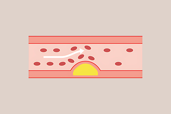 혈관-건강과-심혈관-질환-예방