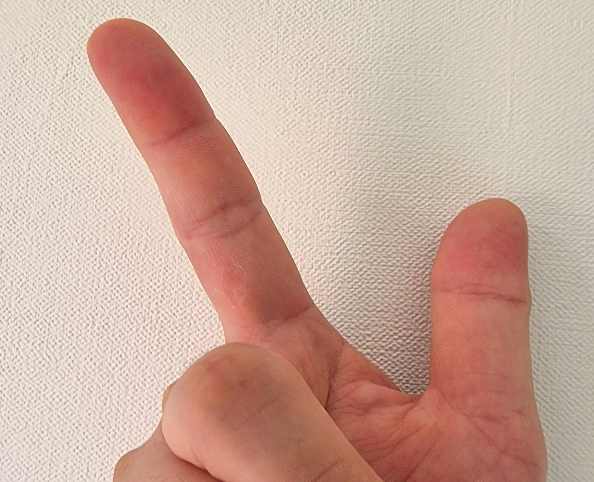 리도멕스 사용 후 개선된 주부습진