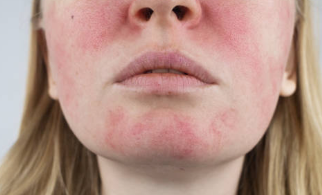 수란트라 크림 부작용