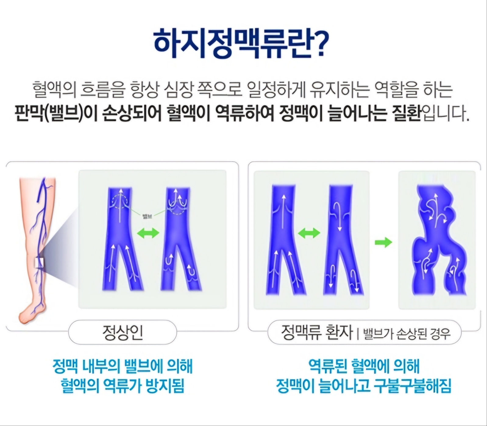 하지정맥의 원인