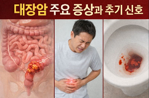 대장암 주요 증상과 초기신호
