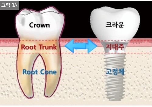 임플란트 보험 임플란트 가격 임플란트 비용 치아 보험 추천 치과 보험 추천 임플란트 치아 보험 치아 보험 적용 기과 보험 적용 치과 보험 임플란트 임플란트 치아