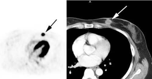 유방암 2cm 이상 퍼제타