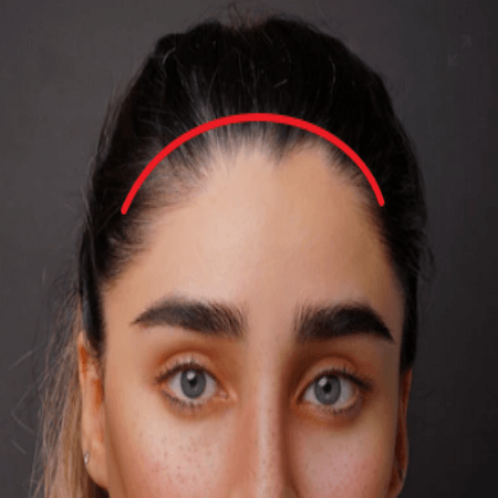 이마거상술 과거 절개 방식