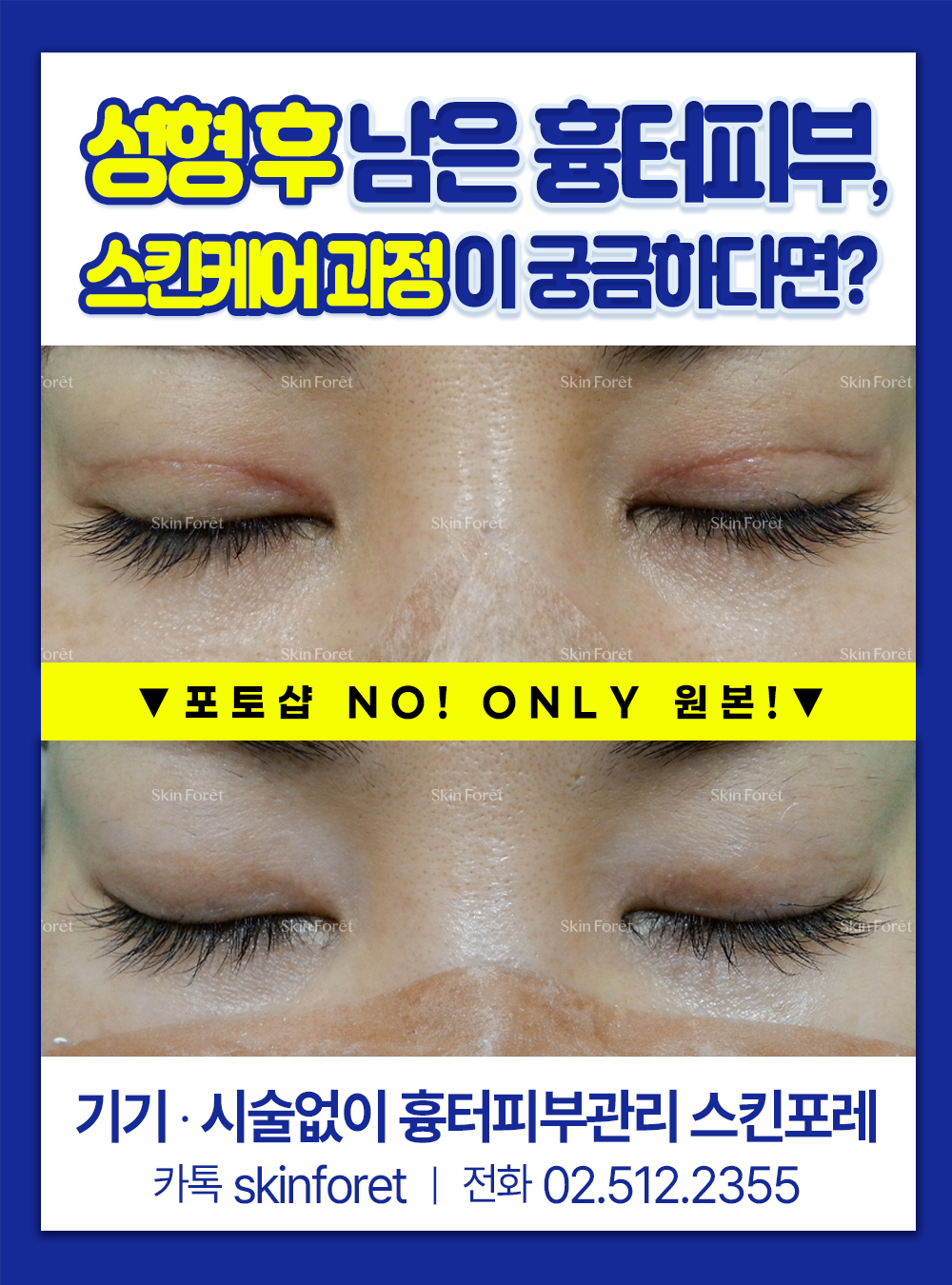 앞트임 흉살 및 흉터 피부 케어 사례