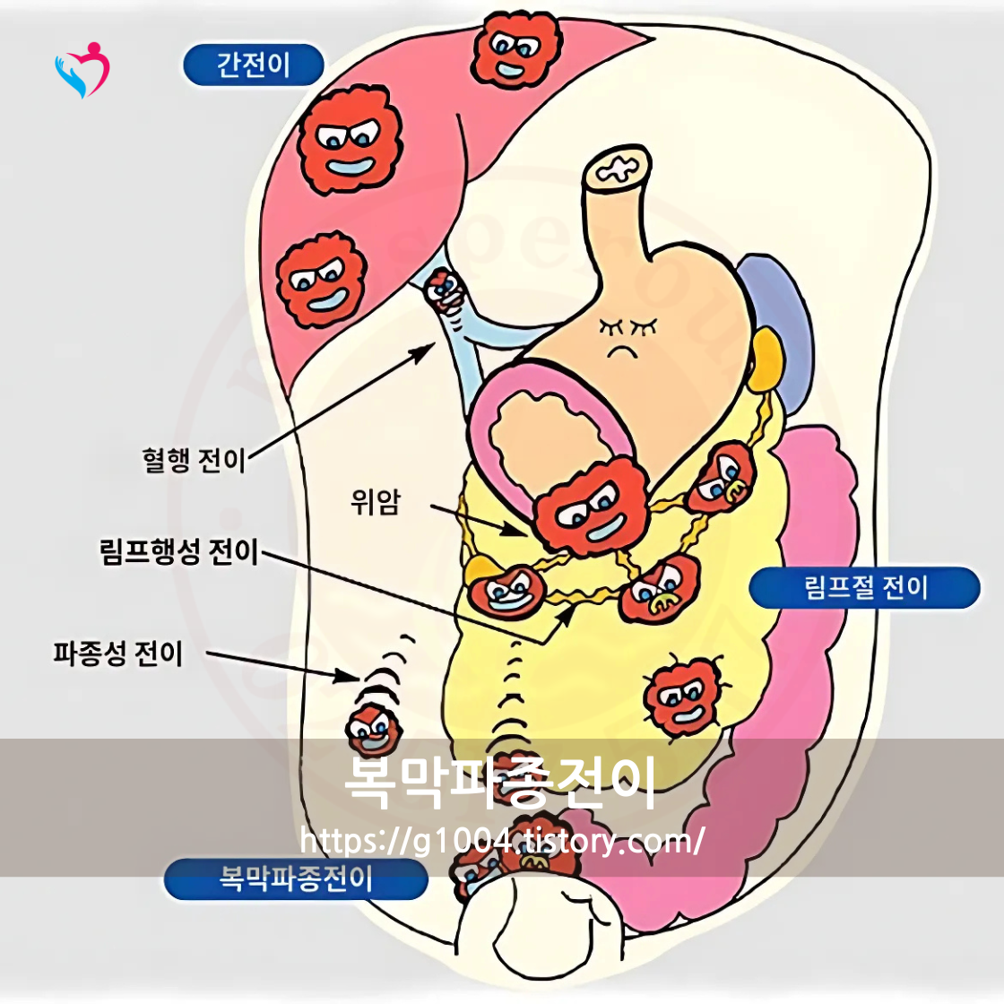 복막파종 전이 복강항암제 치료