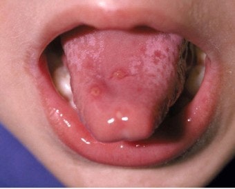 수족구와 수두의 차이점