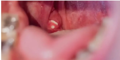 편도 결석 관련 사진