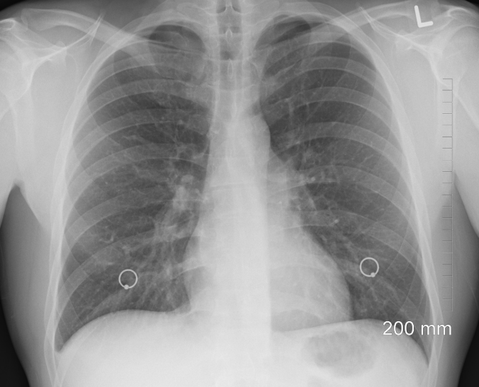 폐질환의 원인과 종류, 예방 및 관리법과 치료의 동향