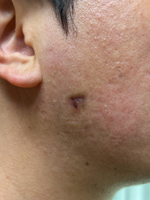 종기-치료직후-사진