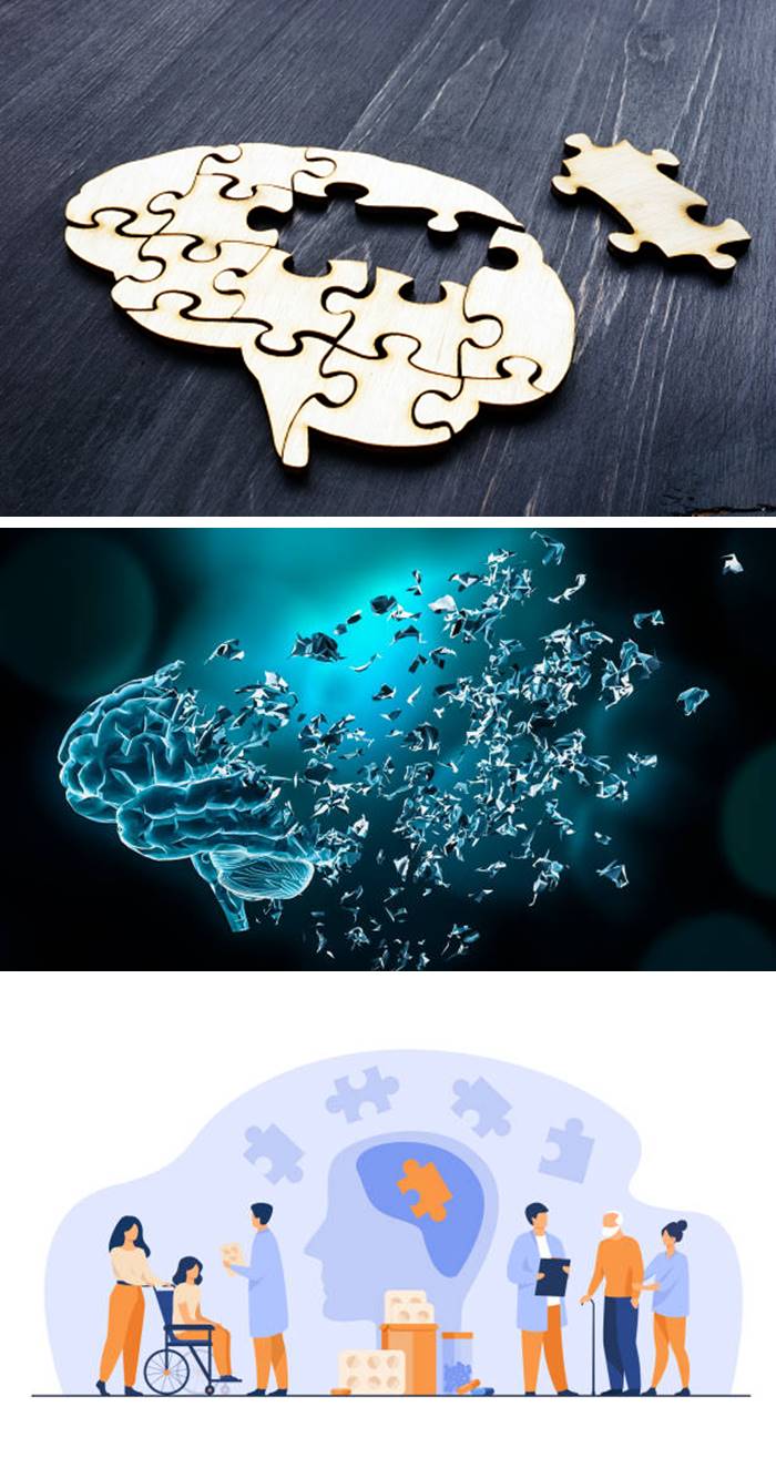 뇌_기억상실_이미지