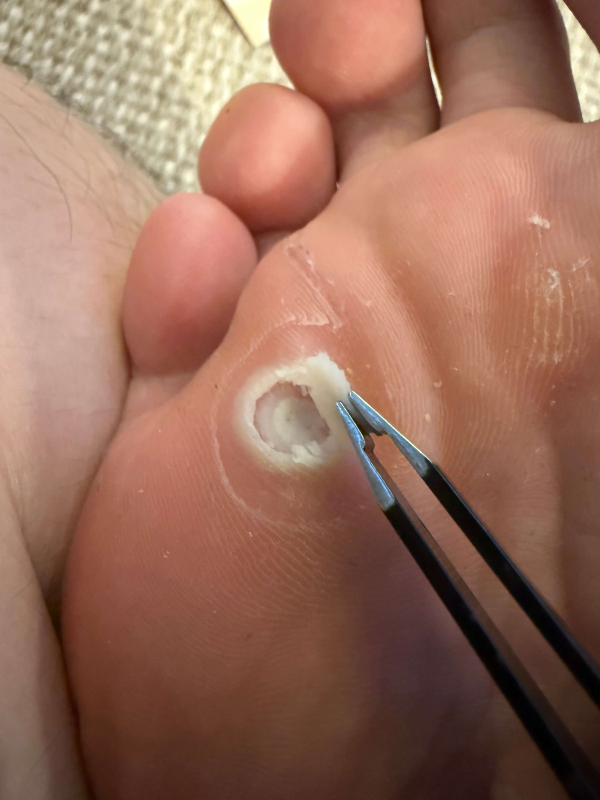 족저사마귀-2차-뚜따-사진