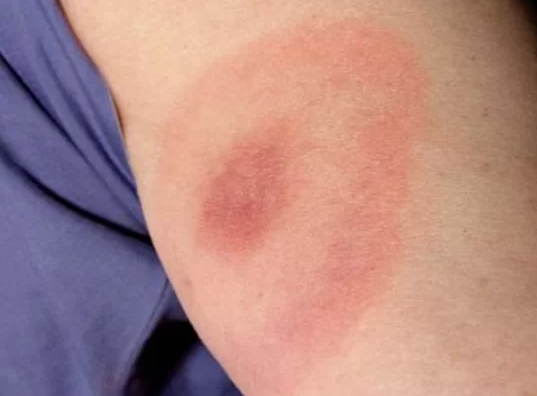 한 라임병 환자의 팔에 붉은 반점과 이를 둘러싼 옅은 고리