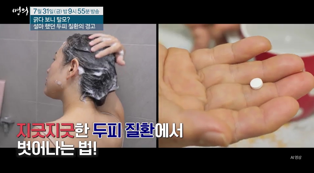 명의 두피질환