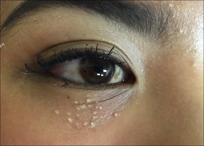 얼굴 좁쌀 두드러기