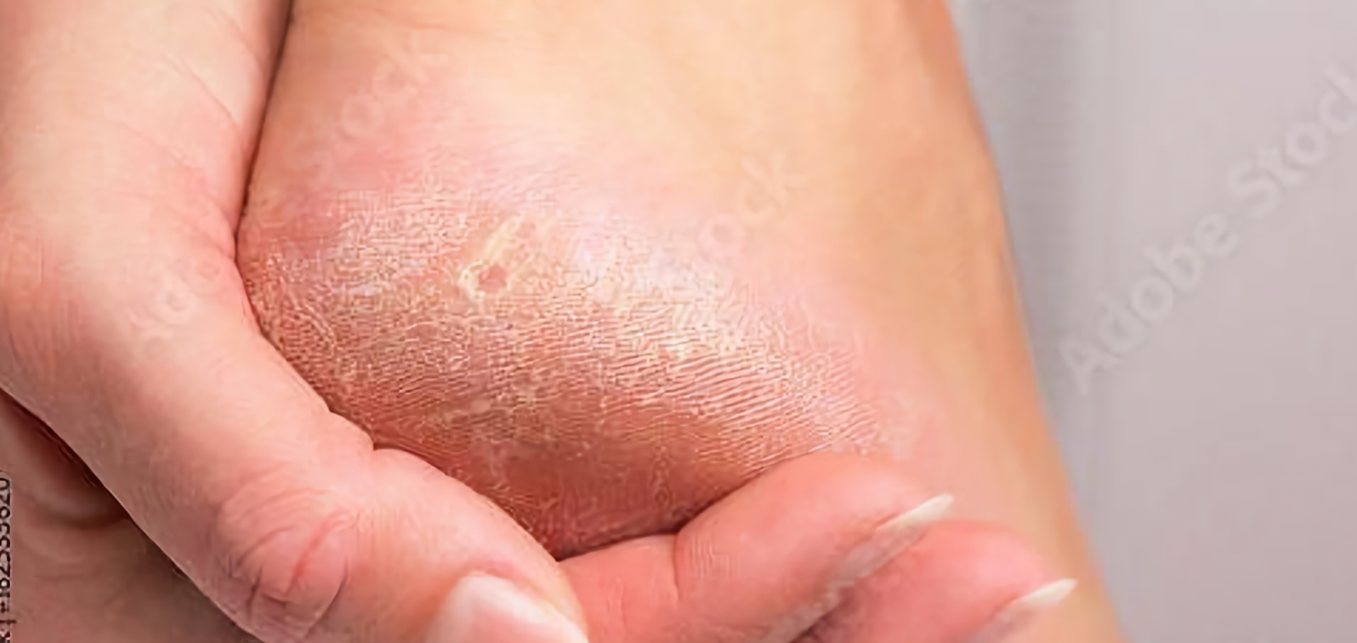 발뒤꿈치 갈라짐,단순 피부 건조? 내분비 이상?에 대해 설명하고 있습니다.