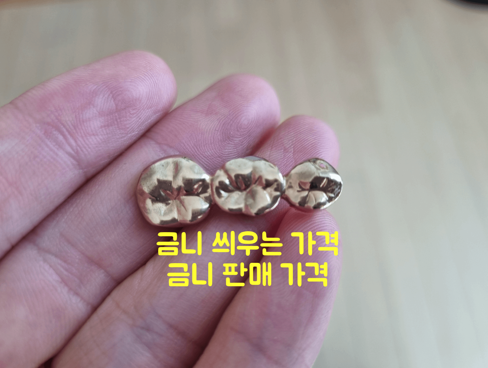 금니 씌우는 가격