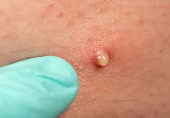 화농성 여드름 연고 3가지 추천