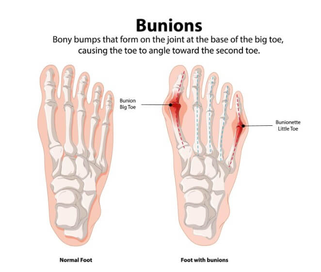 무지외반증 증상 판단