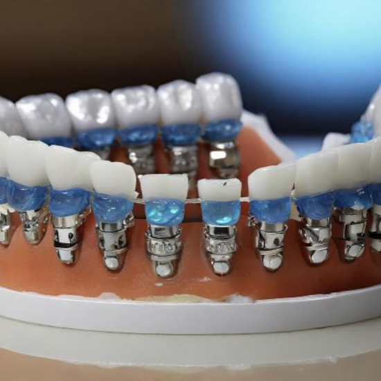 임플란트 시술과정 단계별 설명4