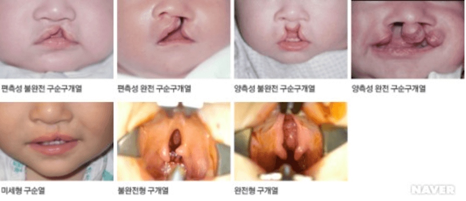 구순구개열