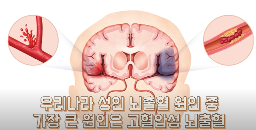 고혈압 합병증