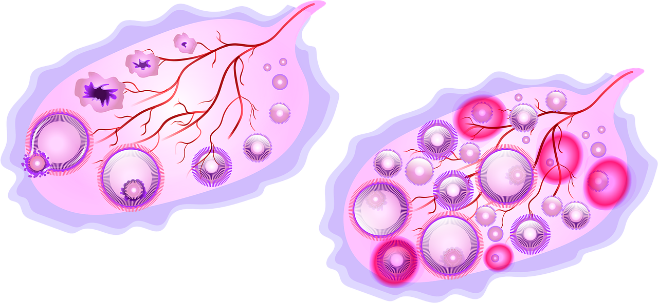 다낭성 난소증후군