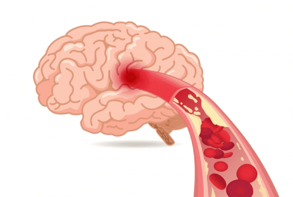 뇌경색-발생-사진