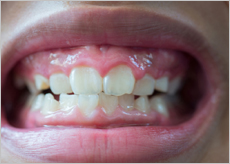 인사돌 효능&amp;#44; 성분&amp;#44; 가격&amp;#44; 잇몸약&amp;#44; 잇몸영양제&amp;#44; 인사돌 이가탄 비교 