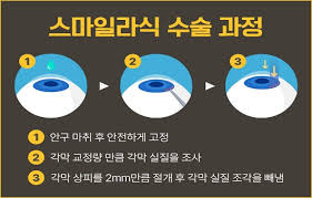스마일 라식