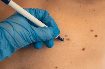 쥐젓 제거 크림의 효과와 사용법