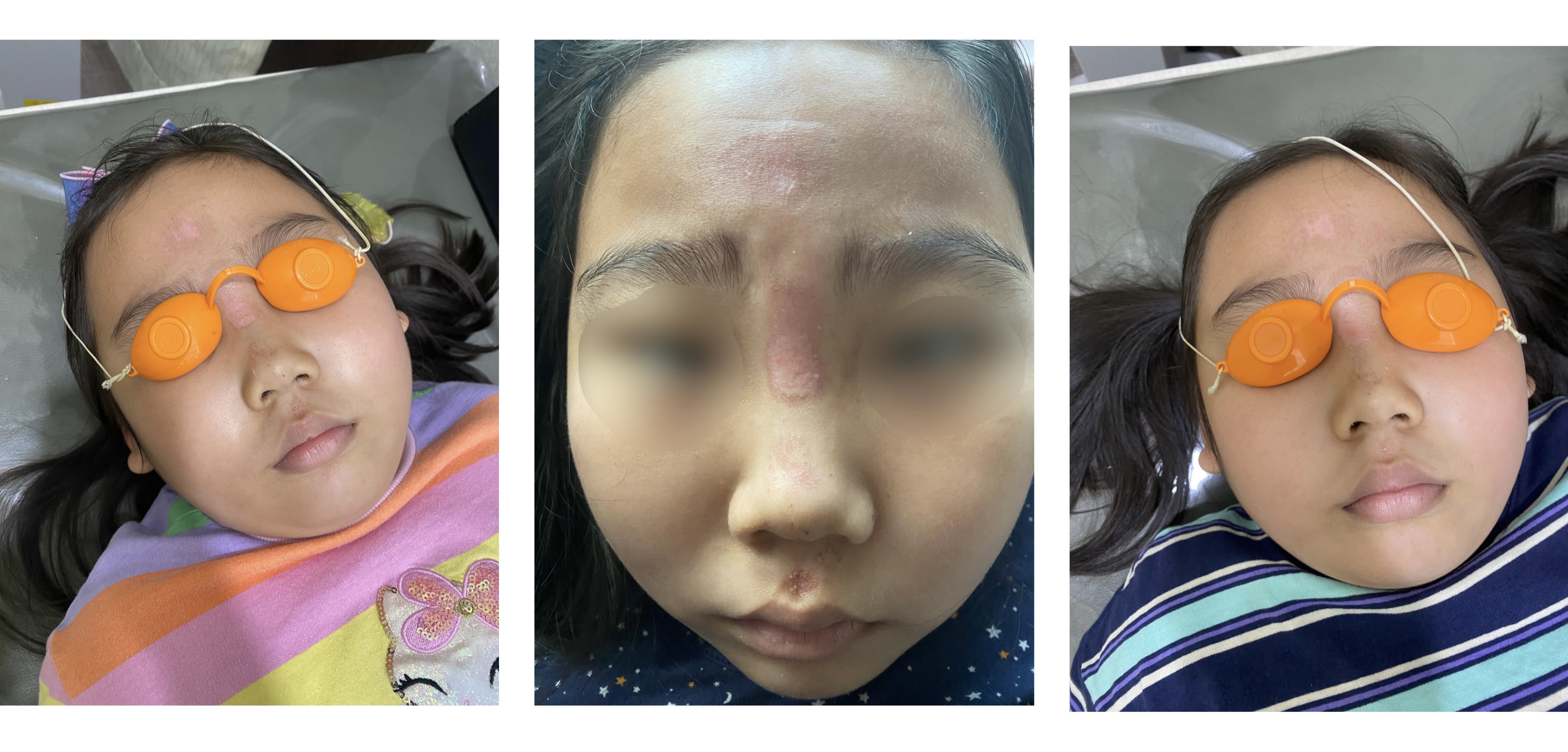 매일 피부과 방문하여 재생레이저 치료 받는 중