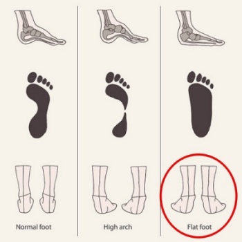 평발-모양-비교