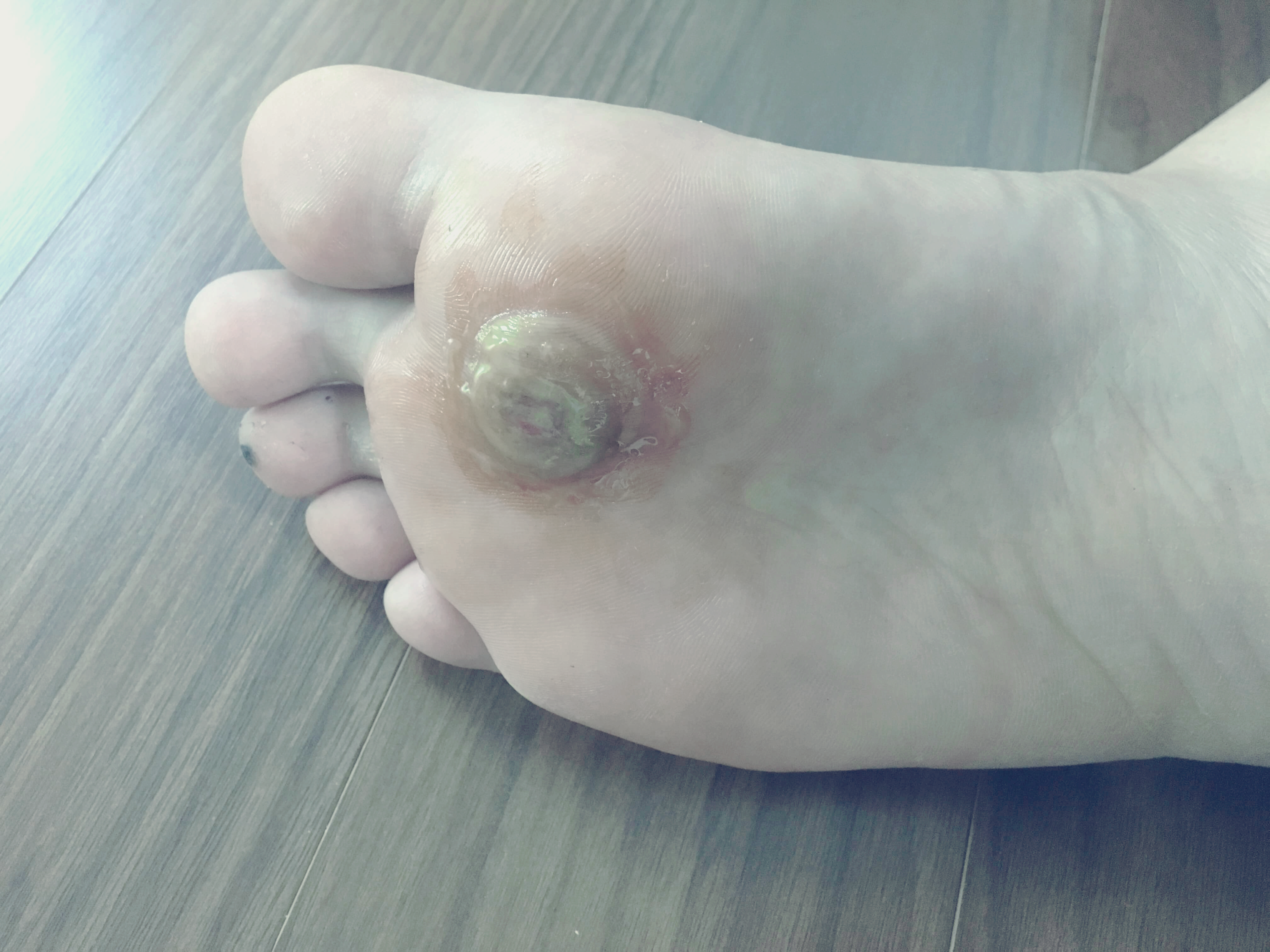 물집이 터지면서 진물이 흘러내립니다.