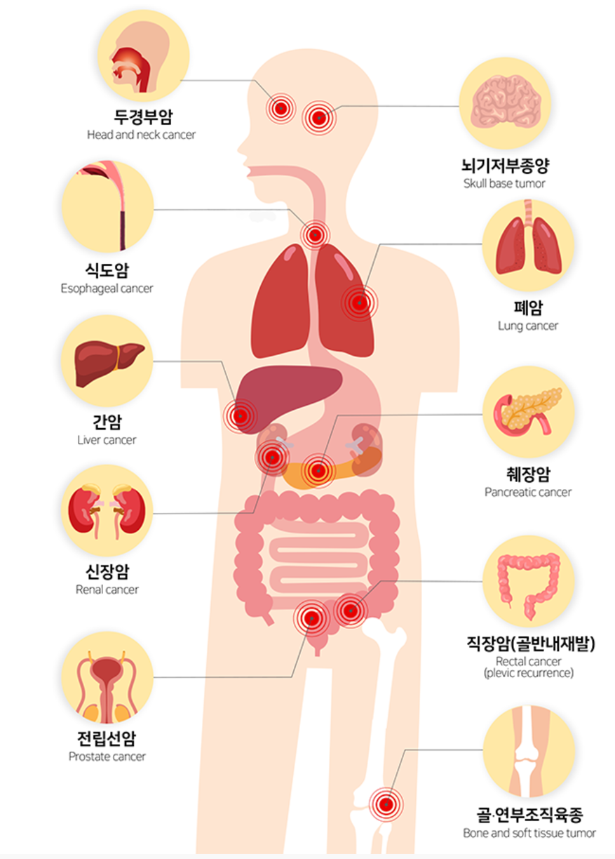 연세의료원 중입자치료 대상 암종