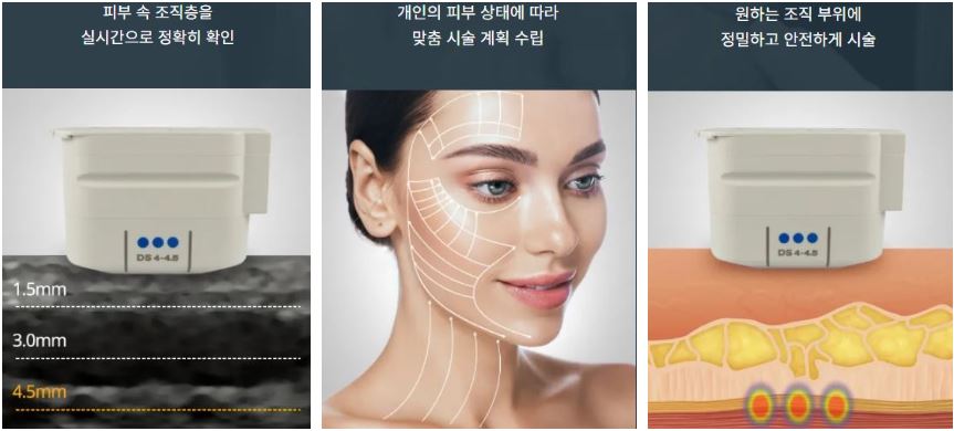 울쎄라 효과 가격