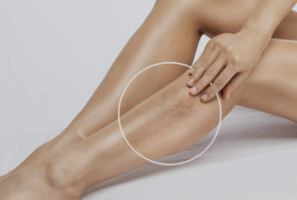 하지정맥류 증상 좋은운동 치료방법 총정리(최신)