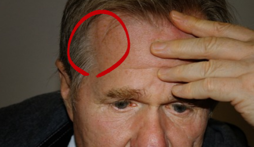 측두동맥염 증상