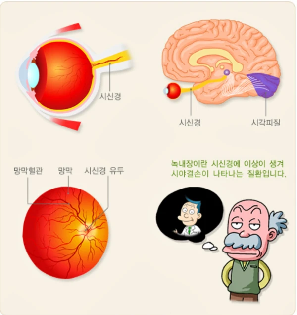녹내장을 이해하기 위해서는 먼저 눈의 구조를 알아야 합니다. 이 이미지는 눈의 구조, 시신경의 구조, 왜 녹내장이 생기는지 설명하는 이미지입니다.