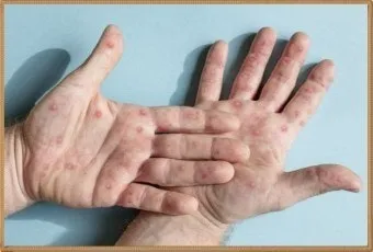 수족구병 증상과 예방 조치 방법 모음_22