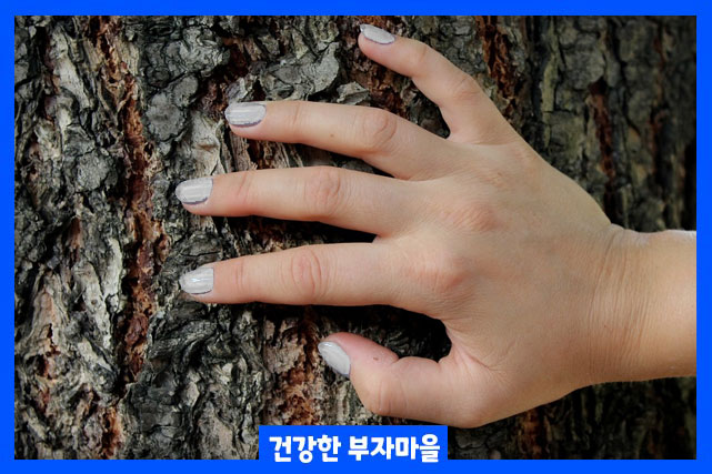손톱이 갈라지는 이유 예방법