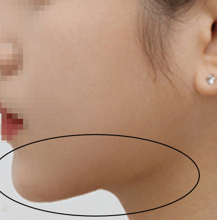 지방흡입 후 여성의 모습