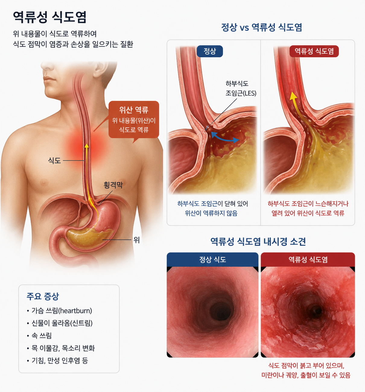 역류성 식도염 설명
