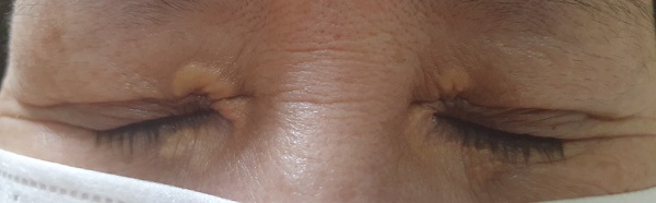 눈꺼풀 황색판종