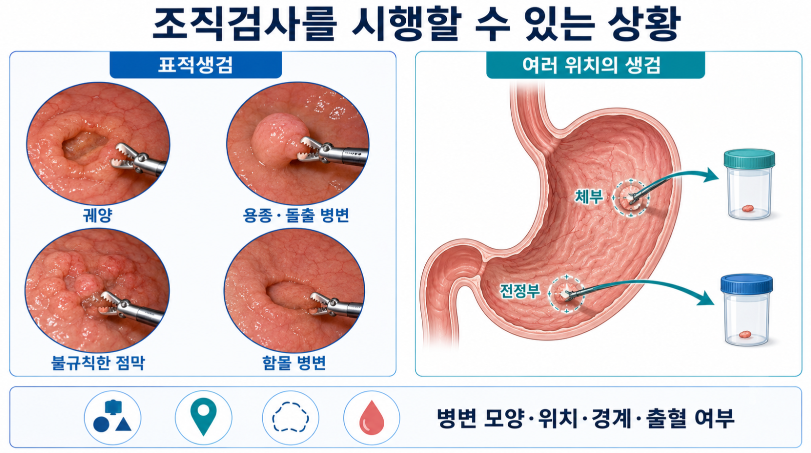 궤양 용종 불규칙한 점막의 표적생검과 전정부 체부의 위치별 생검