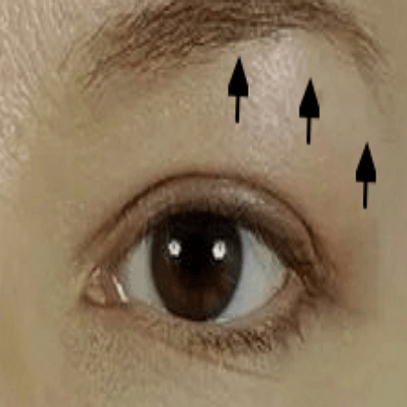 눈썹거상술 후 모습 후기