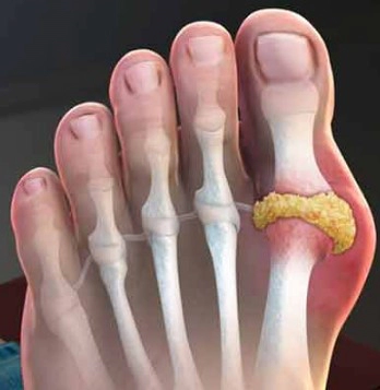 통풍에 좋은 음식 추천