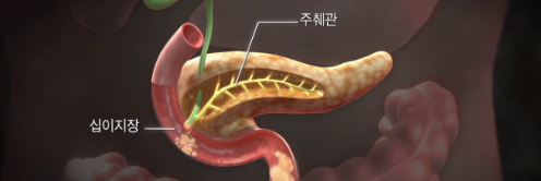췌장암 １