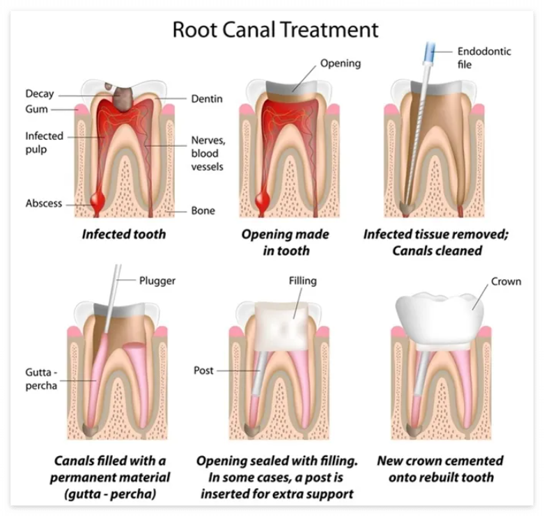치과 신경치료와 크라운치료