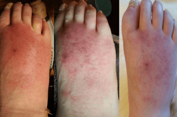 봉와직염의 원인